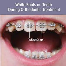 I'm concerned because those teeth aren't connected to the wire yet. answered by dr. How To Reduce Tooth White Spots While Wearing Braces Scott R Smith Dds Pc