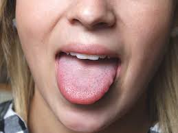 Sore mouth is principally found in sheep and goats. Sore Tongue 15 Possible Causes