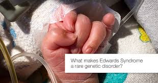 The extra chromosome is lethal for most babies born with this condition. What Makes Edwards Syndrome A Rare Genetic Disorder Apollo Hospitals Blog