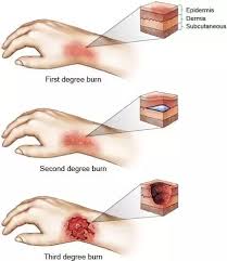 How long do you keep a second degree burn bandaged? What Is A Second Degree Burn Quora