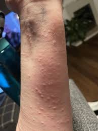 Image result for Exercise-Induced Anaphylaxis