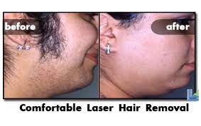 I did a lot of research & read lots of reviews before choosing infinity for laser hair removal. Best St Louis Laser Hair Removal Procedures Cosmetic Surgery In St Louis