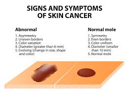 Newer treatments for deep basal cell skin cancers and ones that have spread are being studied in clinical trials. Skin Cancer Los Angeles Mohs Surgeon Santa Monica