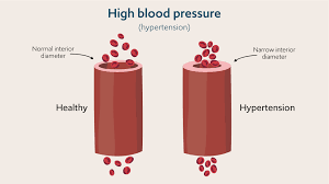 Image result for Hypertension