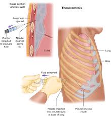 Image result for Thoracentesis