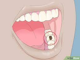 Great for quick great looking fixes for common dental problems including missing or cracked teeth, discolored teeth, covering spaces in teeth, chips, damaged teeth, as well as gum veneers for receding or. 3 Ways To Fix Rotting Teeth Wikihow