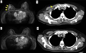 These techniques include ct scans, mri scans and radioisotope scans. Inflammatory Breast Cancer Associated With Amyopathic Dermatomyositis A Case Report Surgical Case Reports Full Text
