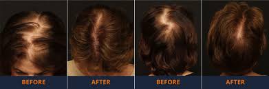 When you visit belgravia or complete our online consultation form, the specialist dealing with your case will recommend the most suitable and effective. Female Hair Loss Treatments Buckhead Hair Restoration