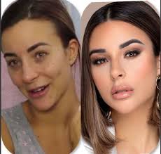 Nabilla à los angeles pour une nouvelle opération de chirurgie esthétique à plus de 70 000€. Reallife On Twitter Avant Apres De Rym Renom Vincentqueijo Rym Nabilla Https T Co Xuffujcsaa Twitter