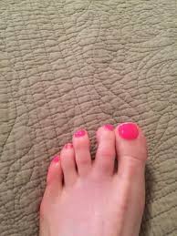 Running Over The Hill Plantar Plate Injuries Injury Running Injuries Running Half Marathons