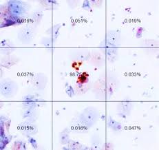 Cervical cancer treatment aims to treat the cancer of the cervix. Ai Approach Improves Cervical Cancer Screening In Nci Study National Cancer Institute