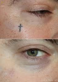 We developed an animal model for traumatic tattoos. Efficient Removal Of Unwanted Tattoos Using Advanced Lasers