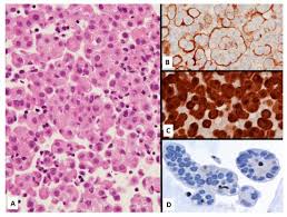 Challenges and controversies in the diagnosis of mesothelioma: Jcm Free Full Text When The Diagnosis Of Mesothelioma Challenges Textbooks And Guidelines Html