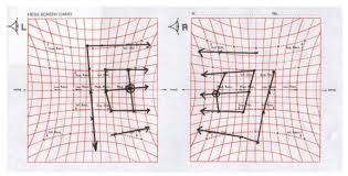 Hess Chart Showing Bilateral Fourth And Sixth Nerve Palsy