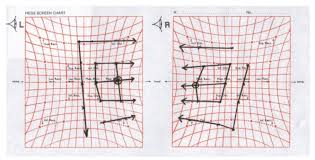 hess chart showing bilateral fourth and sixth nerve palsy