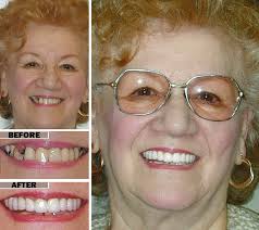 They are a great transition option for those who have had dentures for some time and are looking for more security and stability in their bite. Implant Supported Dentures Brooklyn Cosmetic Dentistry