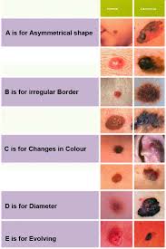 abcde of skin cancer e can also stand for elevation meaning