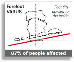Image result for Rearfoot Varus (right foot)