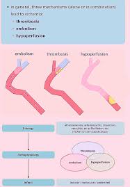 Image result for Stroke Pathophysiology