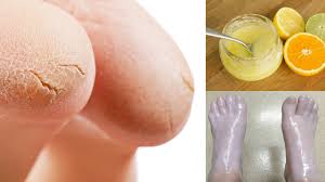 Jetzt bei mac's mystic store die neuesten trends entdecken. 10 Simple Home Remedies For Cracked Heels Youtube