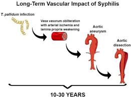 Image result for Cardiovascular Syphilis