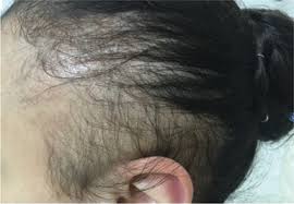 In this case study, two patients developed diffuse hair loss during sertraline treatment. Hair Loss In Children Etiologies And Treatment Intechopen