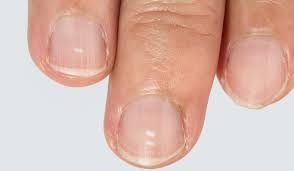 Weisse Flecken Auf Den Nageln Woher Kommen Sie