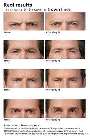 We did not find results for: Botox Cosmetic Treat Crows Feet Frown Forehead Lines
