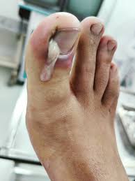 Image result for Paronychia feet