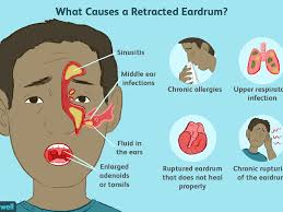 How many times can i take the iq test? Retracted Ear Drum Causes Symptoms And Treatment