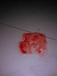 Gambar kanker kulit di tangan. Gambar Muntah Darah Di Tangan