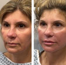 Immediately following The Hourlift🥹 #minifacelifting  #minifaceliftbeforeandafter #blepharoplasty #facelift #faceliftmichigan  #faceliftbeforeandafter #cosmeticsurgery #faceliftexpert  #faceliftspecialist #necklift #skincare #skinandveincenter #beauty ...
