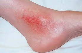 Skin Rash Of The Ankle Varicose Veins Mn Minnesota Vein Center