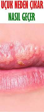 Ucuk Neden Cikar Nasil Gecer Ziyaret Edilecek Yerler Saglik Ipuclari Saglik Ve Saglikli Cilt Bakimi