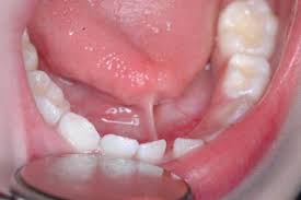 Where can oral cancer appear? How Familiar Are You With Oral Cancer Proprofs Quiz