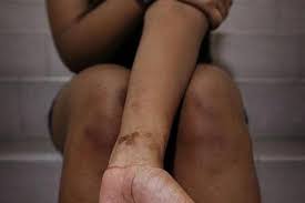 More Singapore Teens Engaging In Self Harm Latest Singapore News The New Paper