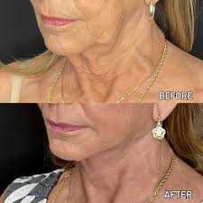 ✨ Transformation Spotlight ✨ Dr. Shah's Face & Necklift with Skin  Resurfacing shows just how powerful a dramatic—but natural—refresh can be!  Here's what was restored: 🔹 Jawline definition