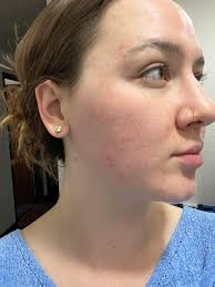 burner skincare regimen recommendations