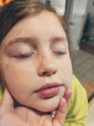 Has anyone experienced a swollen eye suddenly worsening?