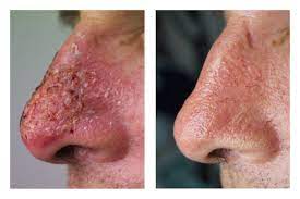 Working as an antimetabolite to prevent cell proliferation, it primarily inhibits the enzyme thymidylate synthase blocking the thymidine formation required for dna synthesis. Efudix Queensland Skin Clinic