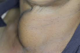 Image result for Goiter