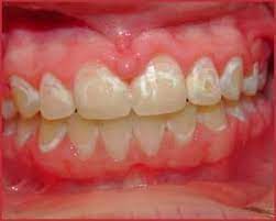 It's caused by a breakdown of the minerals on your teeth beneath the brackets. How To Clean Stains After Braces After Braces Teeth After Braces Braces Tips