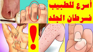 شخص يموت كل ثانية بسرطان الجلد 10 علامات قاتلة من سرطان الجلد تحتاج إلى الانتباه لها في وقت مبكر Youtube
