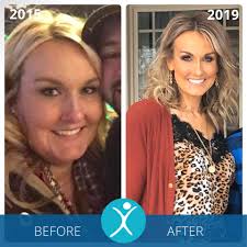 Hair loss after bariatric surgery is very common and very stressful. Gastric Sleeve Before And After Photos The Best Pictures Of 2020