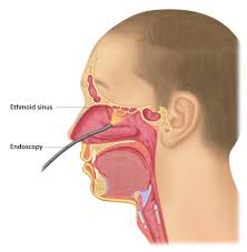 Image result for Rhinosinusitis
