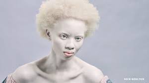 Maybe you would like to learn more about one of these? Bbc Living With Albinism