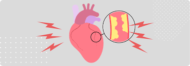 Image result for Angina Pectoris