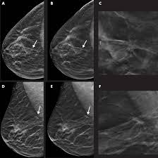 Clinicians should discuss whether to screen for breast cancer with mammography before age 50 years. Tomosynthesis With Synthetic Mammography Improves Breast Cancer Detection Eurekalert Science News