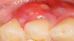 Image result for Periodontal Abscess