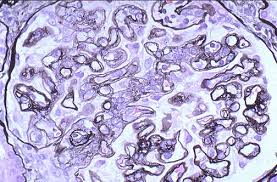 Mpgn Tram Track Silver Stain Pathology Renal Medical Science